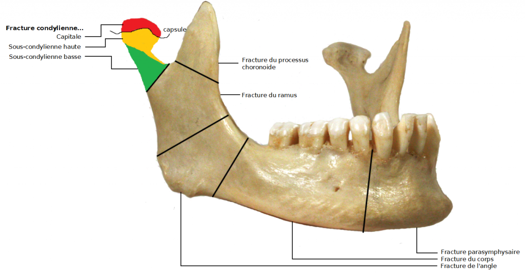 Fracture de la mandibule MedG