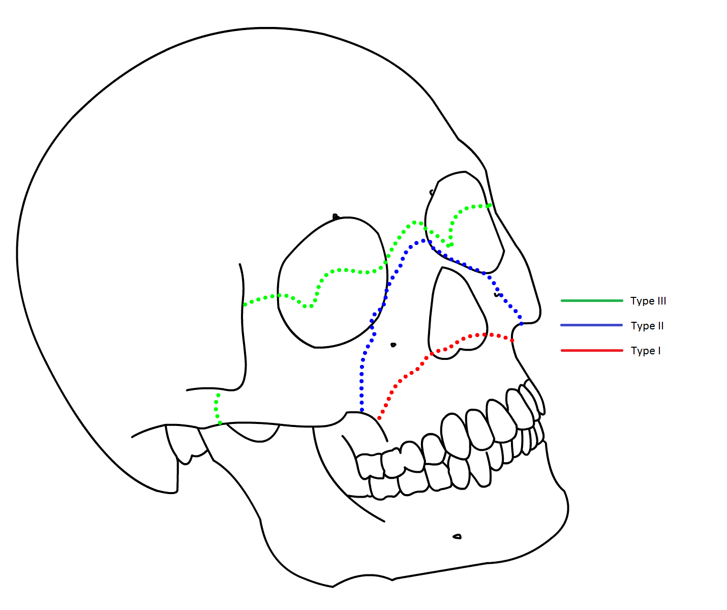 Fracture occlusofaciale de Le Fort - MedG