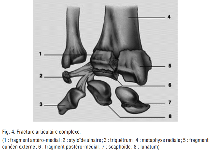 Fracture de l'extrémité inférieure du radius - MedG
